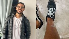 Rodrigo Mussi mostra cicatrizes do acidente pela primeira vez