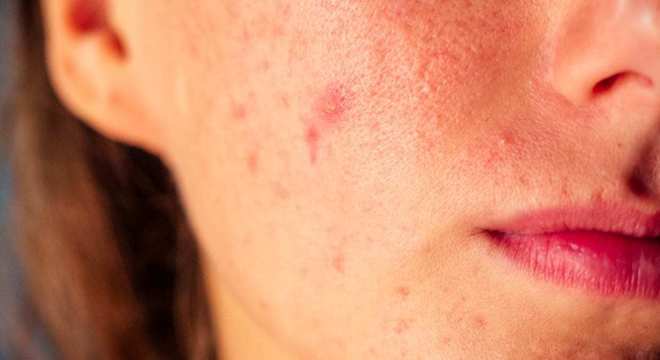 Sabonetes para espinhas- Quais são os melhores e como usá-los