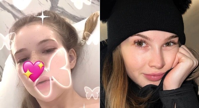 Atriz e influenciadora Sammy passa por cirurgia e precisa refazer parte do nariz: 'Peguei uma bactéria'