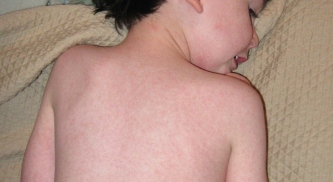 As manchas vermelhas sÃ£o a principal caracterÃ­stica da doenÃ§a