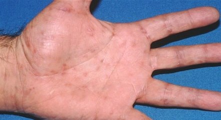 Manchas na palma das mãos e na sola dos pés são sintomas de sífilis secundária