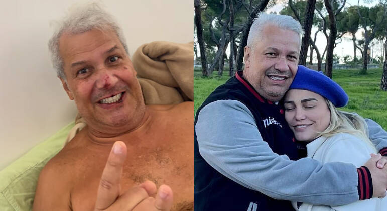 Sikêra Jr. aparece com o rosto machucado após receber alta hospitalar