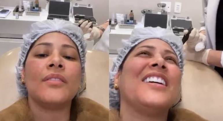 Simaria anunciou procedimento estético