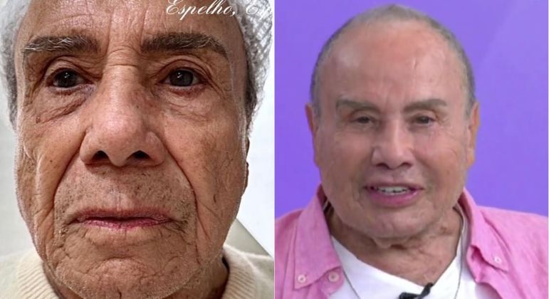 Stênio Garcia passou por uma harmonização facial