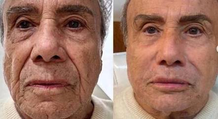 Stenio antes e depois da harmonização