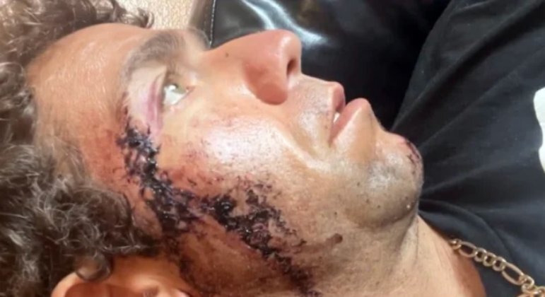 O surfista Mark Sumersett foi mordido no rosto por tubarão, em praia da Flórida (EUA)