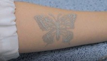 Pesquisadores da Coreia do Sul desenvolvem ‘tatuagem eletrônica’ que monitora a saúde