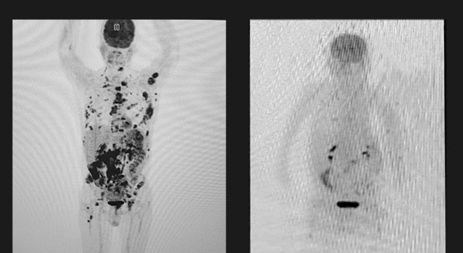 Entenda A Terapia Celular Que Fez Desaparecer Celulas De Linfoma