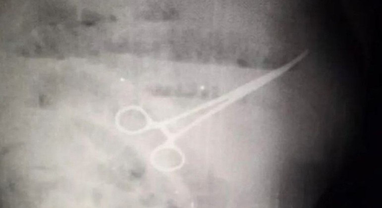 Radiografia mostrou instrumento cirúrgico esquecido