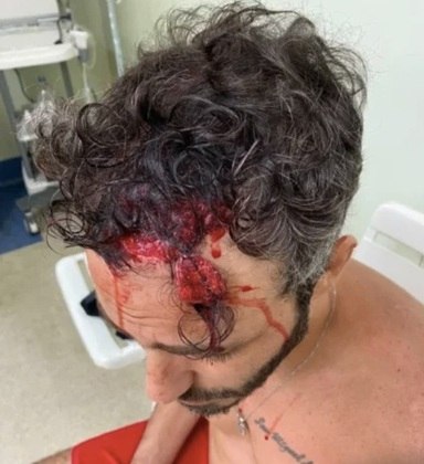 Thiago levou pancadas violentas na cabeça e precisou tomar pontos e fazer exames no hospital antes de ser liberado. 