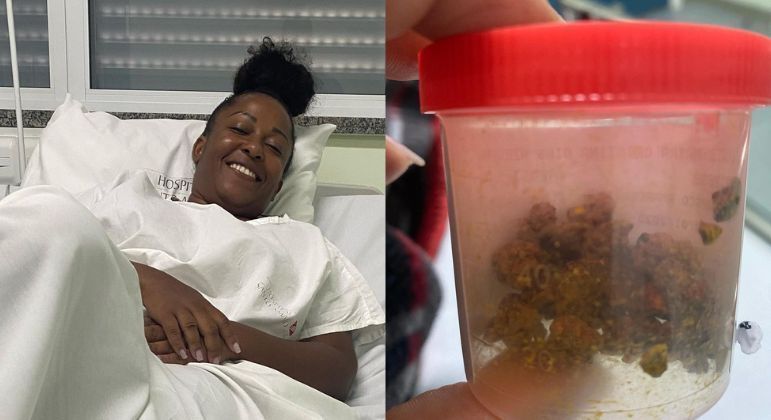 Tia Má conta que retirou mais de 20 pedras da vesícula