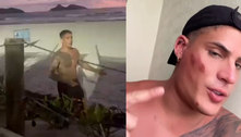Com rosto machucado, Tiago Ramos se defende após brigar em praia 
