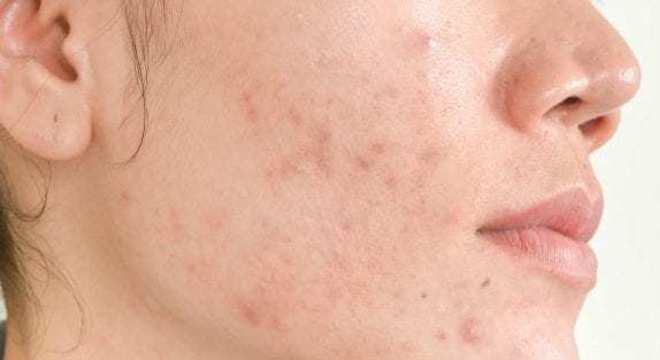 Tipos de pele - quais são, como identificar e cuidar