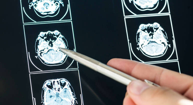Alzheimer continua a ser uma doença sem cura e com diagnóstico geralmente tardio