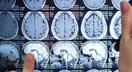 Líquido que protege o cérebro impede a morte das células cancerígenas