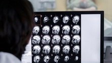 Cientistas conseguem eliminar tumor no cérebro com tratamento sem efeitos colaterais