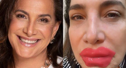 Totia Meirelles aparece com bocão e ironiza harmonização facial  