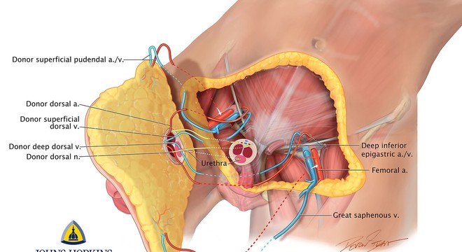 IlustraÃ§Ã£o do transplante total de pÃªnis e escroto da Universidade Johns Hopkins
