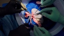 Rim de porco transplantado em humano funciona sem remédios pelo recorde de 32 dias 
