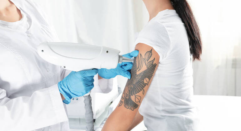 Tudo o que você precisa saber sobre remoção de tatuagem