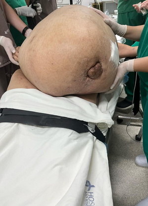 Barriga da paciente que tinha tumor de 46 kg