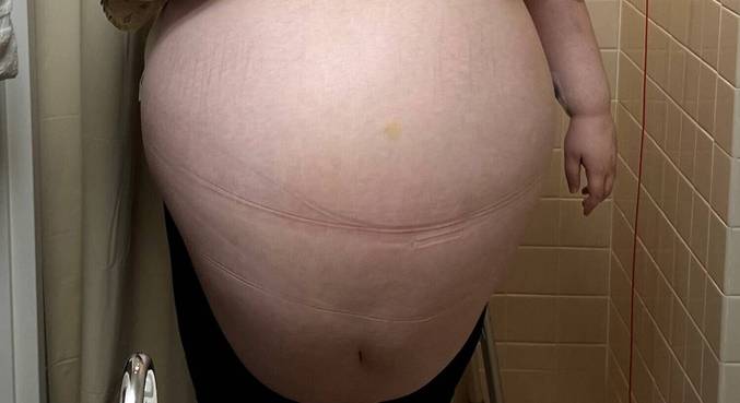 Entre os sintomas do tumor, Allison registrou um ciclo menstrual de um ano inteiro