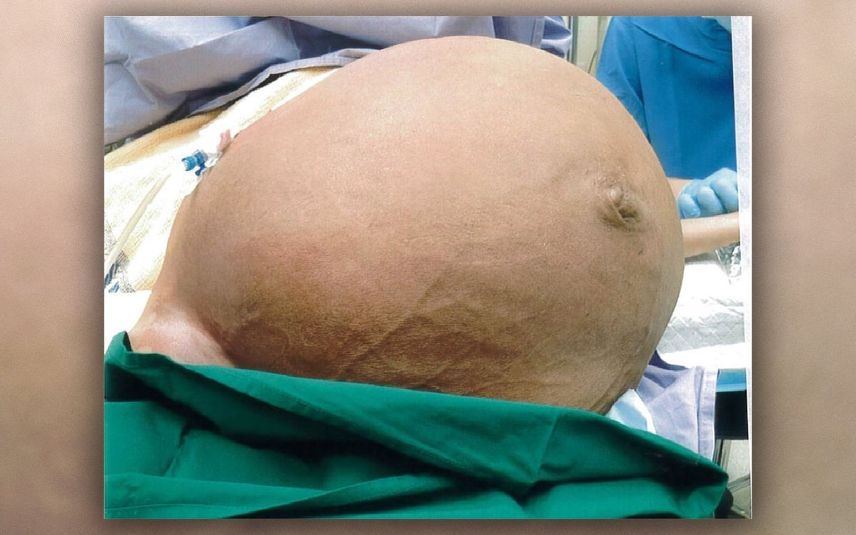 Mulher retira tumor do abdome com peso de uma crian a de 10 anos