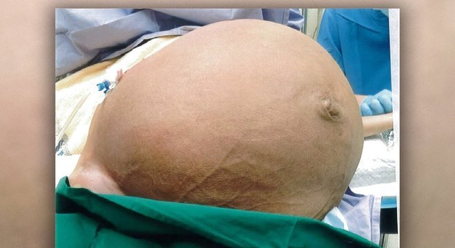 Imagem antes da cirurgia da barriga distendida por causa do mioma de 27 kg