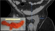 Homem suspeita de hérnia no escroto, mas descobre tumor raro