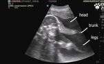 Asha já está com oito meses de gravidez. Na imagem acima podemos ver destacadas a cabeça, a tromba e as pernas do elefantinho
