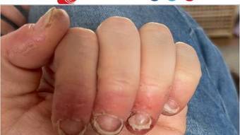 After allergic reaction to gel nails, woman can’t move her hands: ‘Trembling pain’