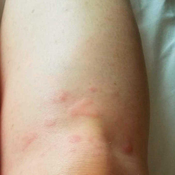 Una mujer desarrolla urticaria y picazón persistente después de recibir la vacuna Covid