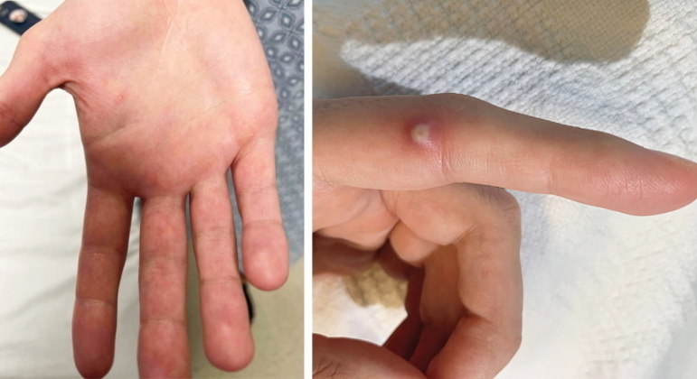 Mão de uma pessoa infectada pela varíola do macaco