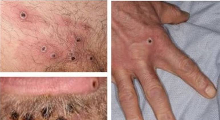 Lesões na pele causadas pela varíola dos macacos