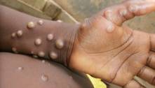 O que é a varíola dos macacos, doença que deixa países europeus em alerta