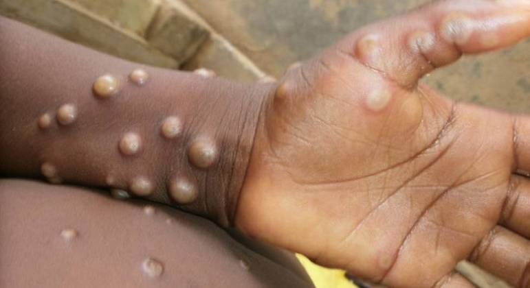 Casos de varíola do macaco têm sido registrados em alguns países africanos