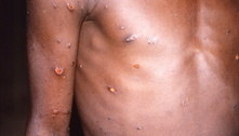 Agência sanitária africana diz que controlou surtos da varíola do macaco durante pandemia