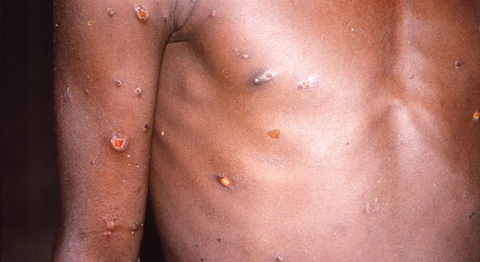 Autoridades Africanas querem entender como a varíola apareceram fora da África
