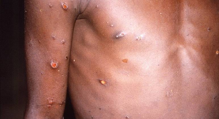 Imunizante contra a varíola também pode proteger contra a varíola dos macacos