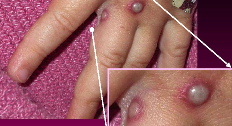 Lesões na pele podem durar até quatro semanas