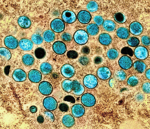 Os casos dos diferentes países têm a mesma origem?O fato de a doença ser detectada em pessoas sem conexão sugere que o vírus pode estar se espalhando silenciosamente. A epidemiologista do CDC (Centro para Prevenção e Controle de Doença) dos Estados Unidos Andrea McCollum considera “profundamente preocupante”.Essa resposta só será possível descobrir a partir das análises genômicas. 