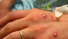 Holanda detecta mais casos de varíola dos macacos, dizem autoridades de saúde