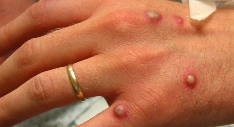 Os sintomas da varíola símia incluem erupções no corpo, febre, dor de cabeça e muscular