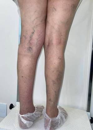 Paciente com quadro de varizes nas pernas
