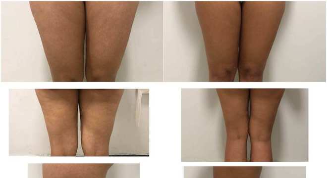 Velashape: Conheça e entenda como funciona