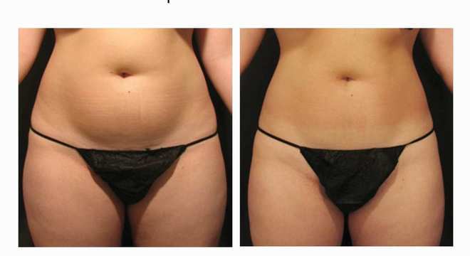 Velashape: Conheça e entenda como funciona