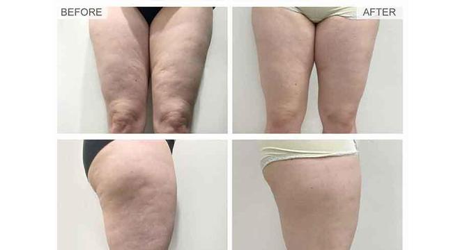 Velashape: Conheça e entenda como funciona