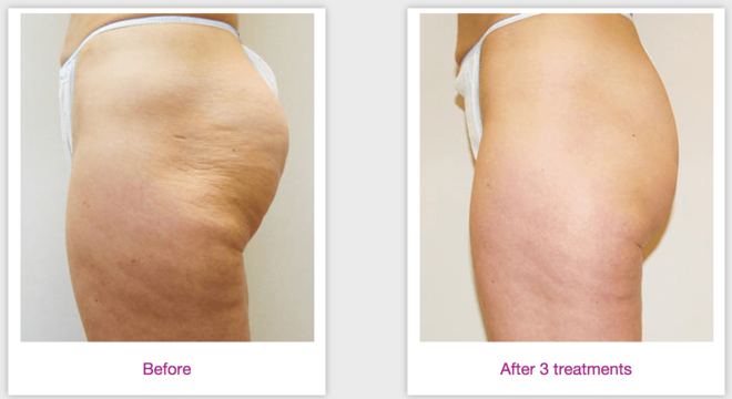 Velashape: Conheça e entenda como funciona