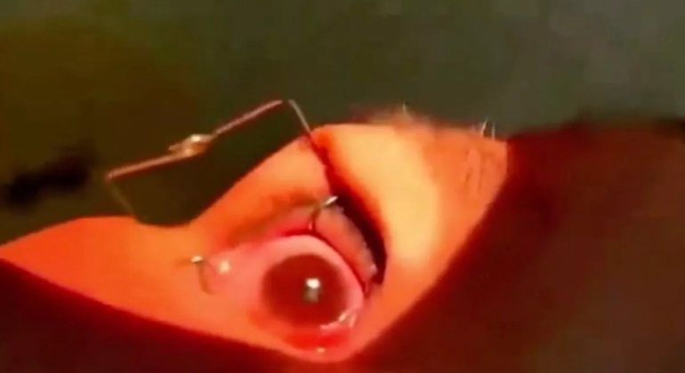 Dezenas de parasitas foram arrancadas de olhos de paciente