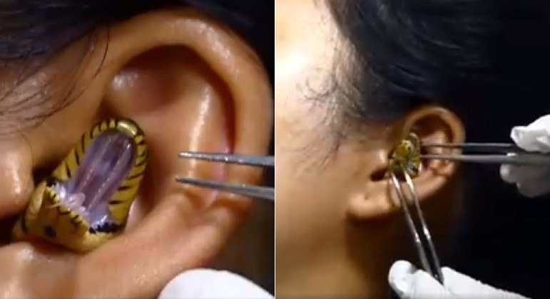 Vídeo mostra serpente (ou parte dela) no ouvido de uma mulher